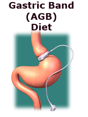 gastric lap band diet